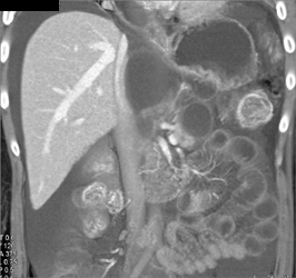 Compressed Inferior Vena Cava (IVC) By Biloma - CTisus CT Scan