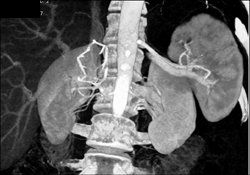 Inferior Vena Cava (IVC) Filter - CTisus CT Scan