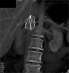 Inferior Vena Cava (IVC) Filter - CTisus CT Scan