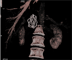 Inferior Vena Cava (IVC) Filter - CTisus CT Scan