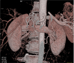 Inferior Vena Cava (IVC) Filter - CTisus CT Scan