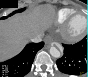 Aortic Dissection - CTisus CT Scan