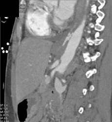 Aortic Dissection - CTisus CT Scan