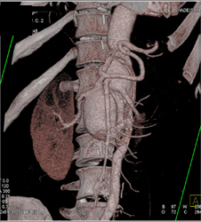 Abdominal Aortic Aneurysm (AAA) at Level of Mesenteric Vessels - CTisus CT Scan