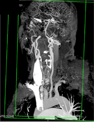 Carotid Artery Stenosis With Editing Tools - CTisus CT Scan