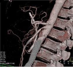 Superior Mesenteric Artery (SMA) Stenosis - CTisus CT Scan