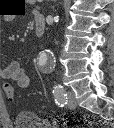 Endoleak - CTisus CT Scan