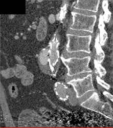 Endoleak - CTisus CT Scan