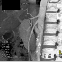 Renal Vein Travels Beneath SMA - CTisus CT Scan