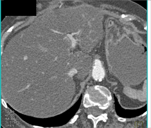 Occluded Shunt to Celiac Artery - CTisus CT Scan