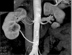 Multiple Right Renal Arteries - CTisus CT Scan