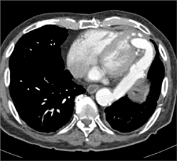 Bypass From Aorta to Left Ventricle - CTisus CT Scan