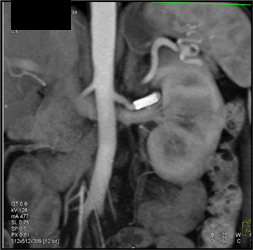 Patent Stent in Left Renal Artery - CTisus CT Scan