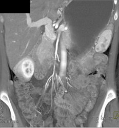 Superior Mesenteric Artery (SMA) Stenosis - CTisus CT Scan