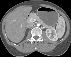 Superior Mesenteric Artery (SMA) Stenosis - CTisus CT Scan