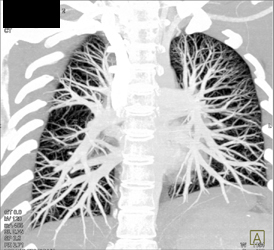 Normal Pulmonary CTA - CTisus CT Scan