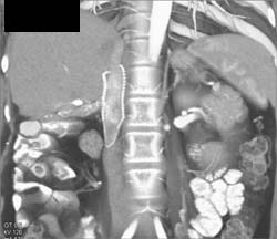 Stent in Inferior Vena Cava (IVC) - CTisus CT Scan