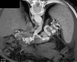 Splenic and Hepatic Artery Aneurysms - CTisus CT Scan