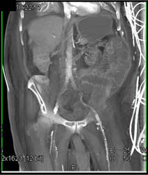 Ischemic Bowel With Small Celiac and SMA - CTisus CT Scan