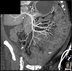 Increased Flow to Small Bowel Due to Ischemia - CTisus CT Scan