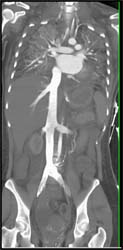 Opacified IVC and Renal Veins - CTisus CT Scan