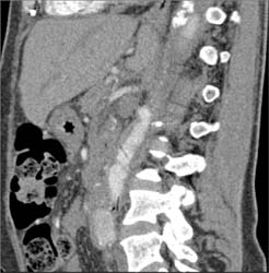 Celiac Artery Aneurysm - CTisus CT Scan