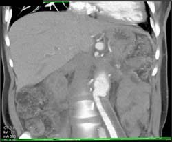 Celiac Artery Aneurysm - CTisus CT Scan