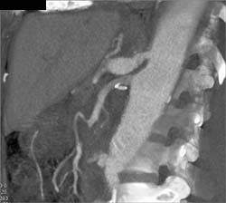 Celiac Artery Aneurysm - CTisus CT Scan