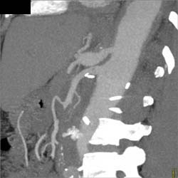 Celiac Artery Aneurysm - CTisus CT Scan