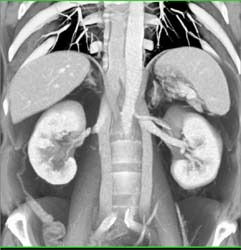 Duplicated Inferior Vena Cava (IVC) - CTisus CT Scan