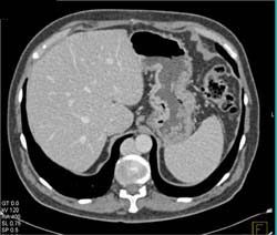 Duplicated Inferior Vena Cava (IVC) - CTisus CT Scan