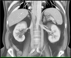 Duplicated Inferior Vena Cava (IVC) - CTisus CT Scan