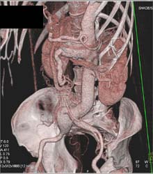 SMA Aneurysm in A Patient With Loeys-Dietz Syndrome - CTisus CT Scan