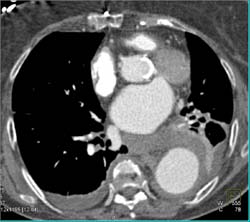 Aortic Leak - CTisus CT Scan