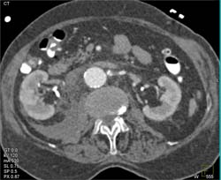 Leak From Aorta Into Right Posterior Pararenal Space - CTisus CT Scan