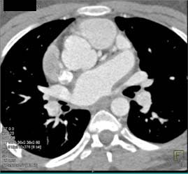 Pulmonary Hypertension - CTisus CT Scan