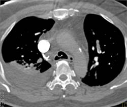 Pulmonary Embolism - CTisus CT Scan