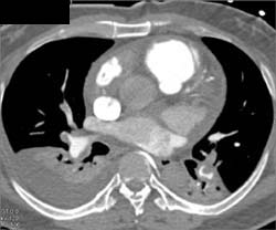 Pulmonary Embolism - CTisus CT Scan