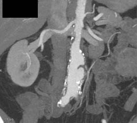 Aortic Ulcer - CTisus CT Scan