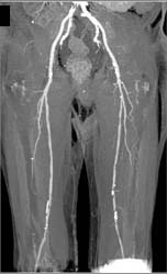 Peripheral Vascular Disease (PVD) With Examples of Bone Removal Tool - CTisus CT Scan