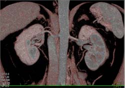 Normal Renal Arteries - CTisus CT Scan