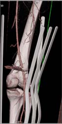 GSW Knee With Metal Artifact - CTisus CT Scan