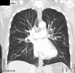 Pulmonary Vasculature Using MIP and VRT - CTisus CT Scan