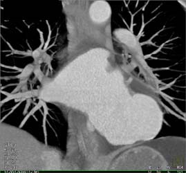 Left Atrial Aneurysm - CTisus CT Scan