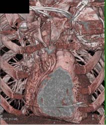 Reimplantation of Right Coronary Artery - CTisus CT Scan