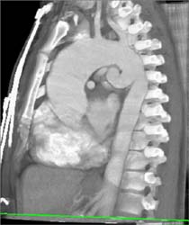 Dilated Ascending Aorta With Pulmonary Atresia? - CTisus CT Scan