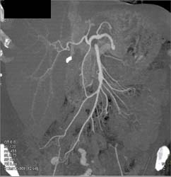 SMA Branching - CTisus CT Scan