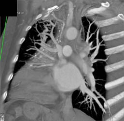 Arteriovenous Malformation (AVM) of Left Upper Lobe in Bypass Patient - CTisus CT Scan