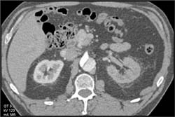 Aortic Dissection With Differential Flow to the Kidneys - CTisus CT Scan