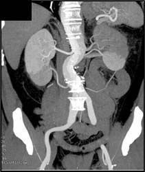 Aortic Dissection With Excellent Example of Differential Renal Perfusion Due to Renal Artery Arising Off True and False Lumen - CTisus CT Scan